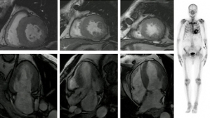 Cas clinique - Une hémopathie bénigne, une HVG maligne