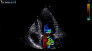 Insuffisance mitrale sévère et syndrome des antiphospholipides chez une jeune femme