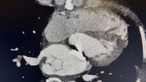 Complication rare d’un remplacement valvulaire mitral évoluant à bas bruit