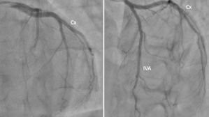 Infarctus du myocarde récurrents…