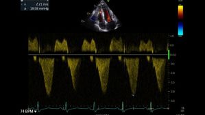 Vous avez dit cardiomyopathie obstructive ?
