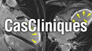 Imagerie cardiaque : cas clinique "Attention infarctus du myocarde méchant !"