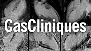 Cas clinique de l’extrême : au-delà de la nécrose myocardique…