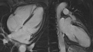 Imagerie cardiaque - Une lésion sans coupable
