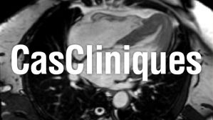 Imagerie cardiaque : cas clinique "Toutes les hypertrophies ventriculaires gauches ne se valent pas !"