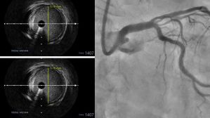 Quand l’imagerie endocoronaire éclaire une angioplastie 