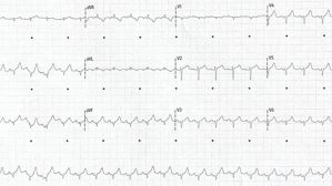 Une hypertrophie ventriculaire gauche soudaine…