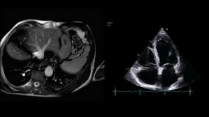 Quand la scintigraphie osseuse ne suffit pas pour poser le diagnostic d'une amylose ATTR