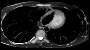 Le syndrome du caméléon : quand la cardiomyopathie hypertrophique se fait passer pour une autre