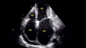 Une arythmie peut cacher un trouble de la conduction… et une cardiomyopathie restrictive