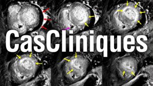 Imagerie cardiaque : cas clinique "Bilan d’HVG : et si ce n’était pas si simple que ça…"