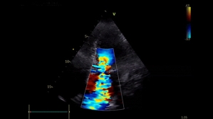Un ventricule qui s’autolyse