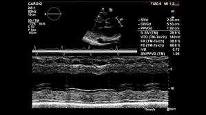 Syndrome oedémateux sur insuffisance diagnostique aigue