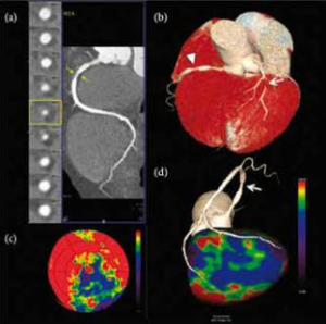 Scanner coronaire de perfusion et FFR-CT - Figure 2