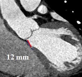Septum membraneux