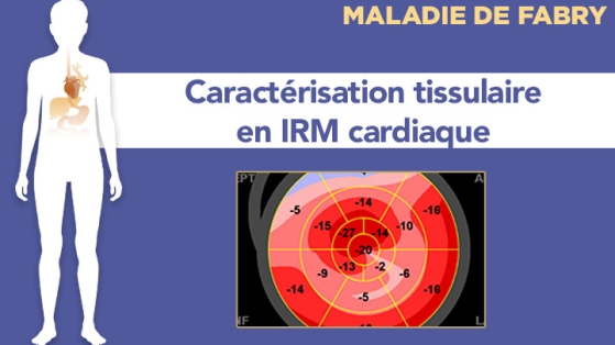 Utilité de la caractérisation tissulaire en IRM cardiaque en cas de CMH ou d’HVG inexpliquée