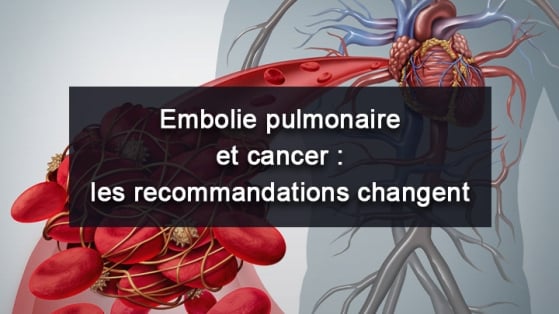 Embolie pulmonaire et cancer : les recommandations changent