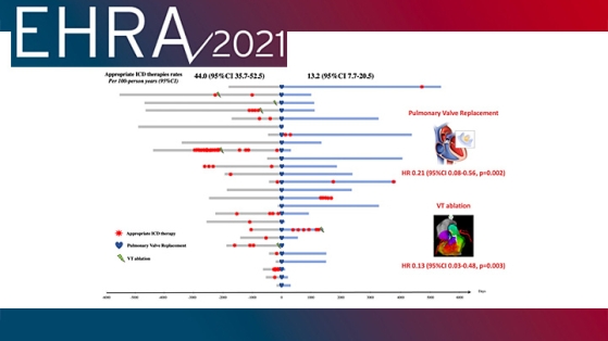 EHRA 2021 : impact de la valvulation pulmonaire sur les arythmies ventriculaires chez les patients avec tétralogie de Fallot - dernières données du registre DAI-T4F