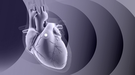 EARLY TAVR : repenser l'indication du TAVI chez les patients asymptomatiques