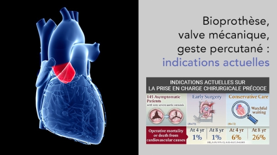 Rétrécissement aortique : remplacement valvulaire biologique conventionnel (chirurgie) ou percutané (TAVI) ?