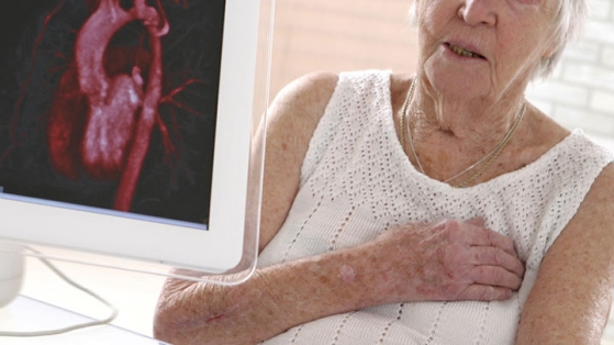 Plus de 10% des patients avec un lymphome traités par CHOP développent une insuffisance cardiaque