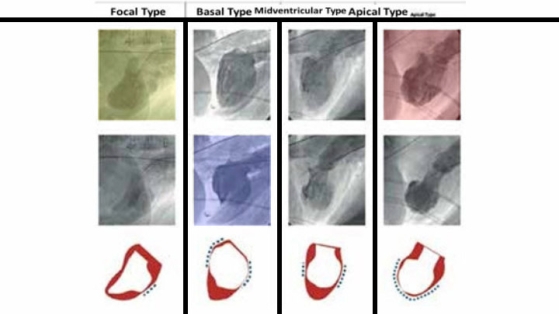 Syndrome de Tako-Tsubo : recommandations/consensus ESC 2018