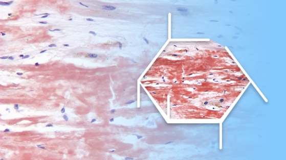 Amyloses cardiaques valvulaires