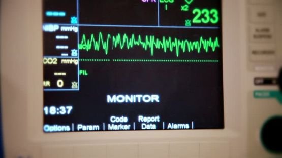 Fibrillation atriale  l'ablation des zones de bas voltage augmenterait le risque d'insuffisance cardiaque