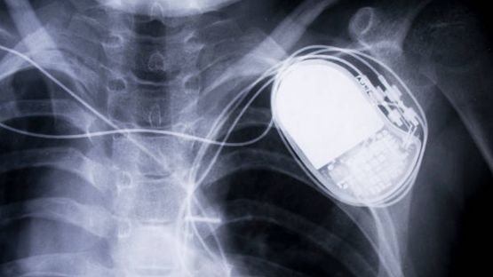 Intérêt potentiel d'un défibrillateur implantable dans des insuffisances cardiaques actuellement non éligibles