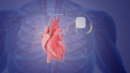 Insuffisance cardiaque  le défibrillateur implantable garde un bénéfice, même avec un inhibiteur de SGLT2