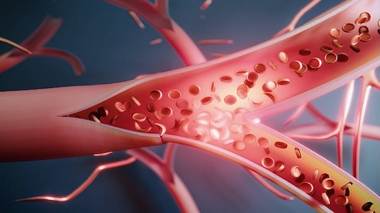 Pose de stent chez le patient avec fibrillation atriale: un mois de bithérapie antithrombotique peut suffire, suivi de l'AOD seul