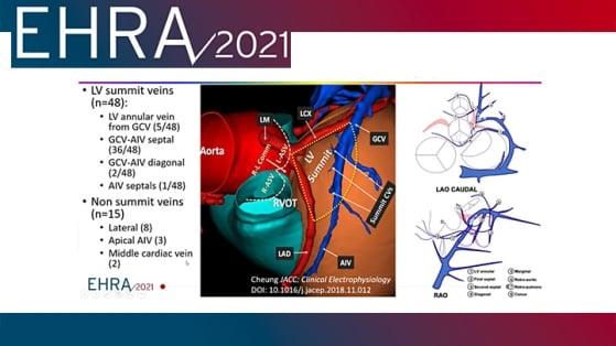 EHRA 2021 : que faire en cas d’échec de l’ablation conventionnelle de tachycardie ventriculaire ?