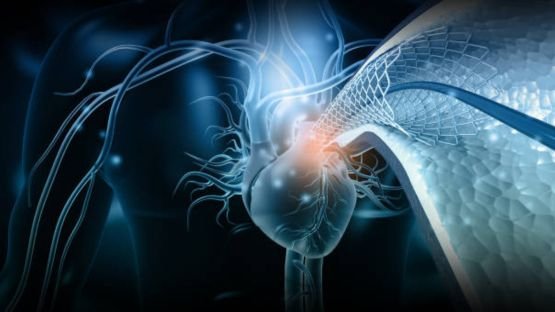 Sténose aortique: le TAVI associé à un surrisque de décès à moyen et long termes (étude française en vie réelle)