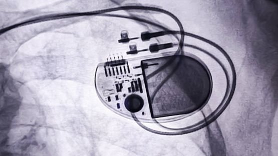 Identification d'une caractéristique à l'ECG permettant de mieux sélectionner les candidats à un défibrillateur implantable