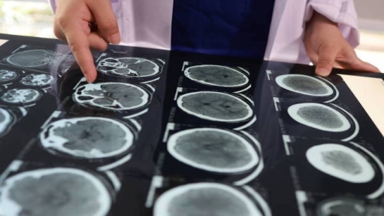 Identification de facteurs prédictifs de récidive d'AVC chez des patients avec une fibrillation atriale sous anticoagulation orale