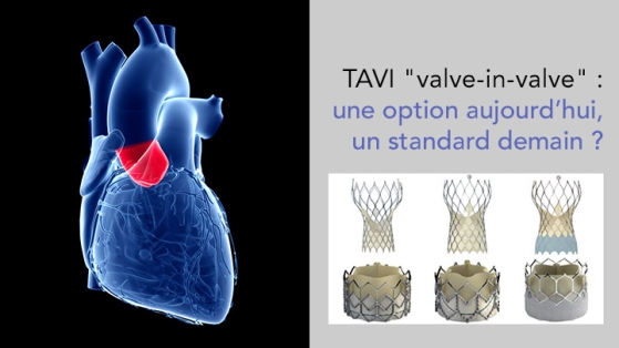 TAVI valve-in-valve pour bioprothèse chirurgicale dégénérée