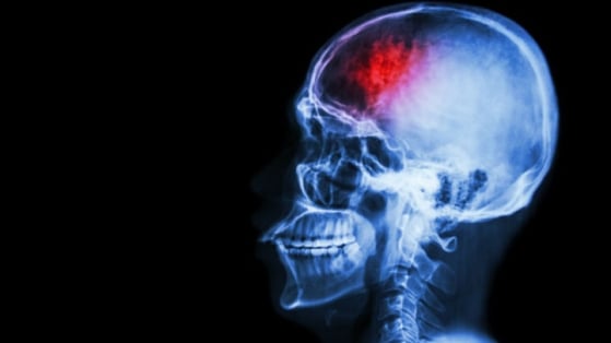 AVC : la thrombectomie associée à un risque accru de décès en cas d'endocardite infectieuse