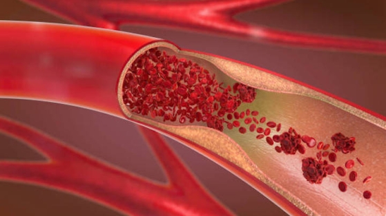 Premiers résultats comparatifs d'efficacité et de sécurité prometteurs pour un stent actif biorésorbable en fer