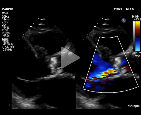 TAVI-dans-l-endocardite-aortique-destructrice-video1-img.jpg