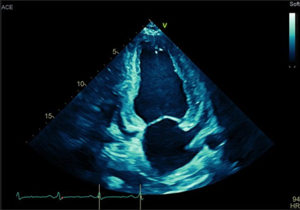 Examens du patient : Echocardiographie bilan de dyspnée , en RS