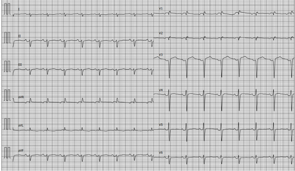 ECG