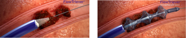 Figure 1. Illustration du dispositif FlowTriever (InariMedical©)