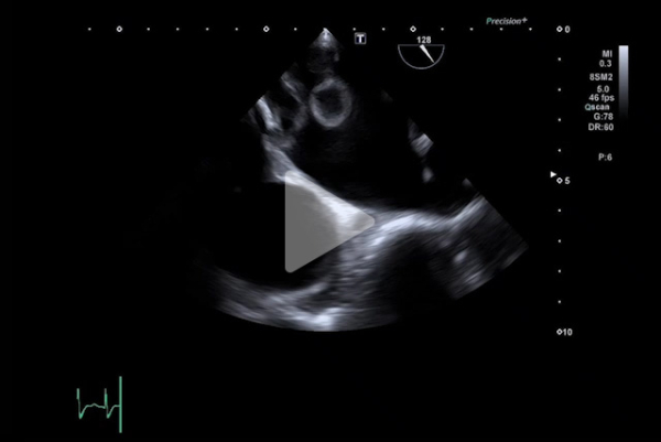 Complication-rare-d-un-remplacement-valvulaire-mitrale-video6-img.jpg