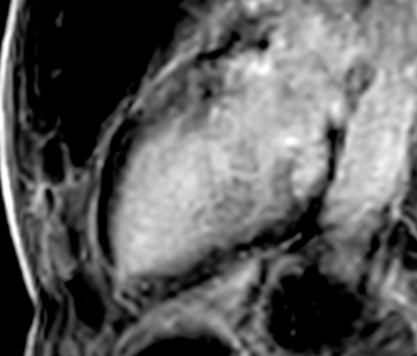 Image 10 du cas clinique "Une amylose pas comme les autres" - IRM myocardique