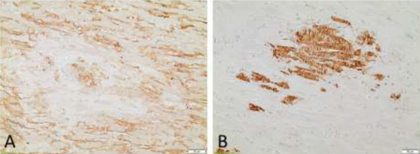 Figure 1. Cas numero 3, tissue myocardique, immunomarquage montrant une fixation lambda (A) et une fixation TTR (B).