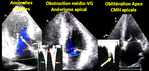 Figure 2 : écho 2D permettant de différencier anomalies structurelles mitrales majeures, obstruction médico-VG et oblitération apicale systolique