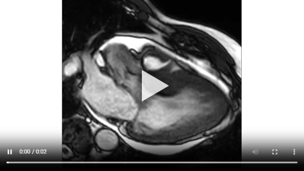 Vidéo 1 : Ciné-IRM montrant un flux d’obstruction sous-aortique en regard d’une zone d’hypertrophie septale associée à une régurgitation mitrale