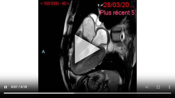 IRM : ciné LVOT