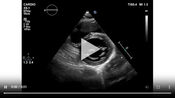 Vidéo 6. Coupe parasternale petit axe à 4 mois