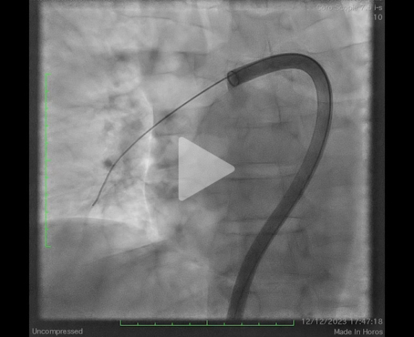 un-infarctus-mais-pas-du-myocarde-vidéo4-img